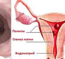 Uklanjanje endometrija polipa: kako postupamo