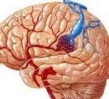Venski angioma mozga (mali mozak, frontalnog režnja)