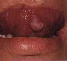 Vrste oralnih: benigni tumori uzroka, simptoma, liječenje