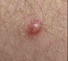 Papiloma virus u muškaraca: kako ga liječiti