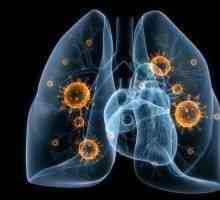 Virusne upale pluća - uzroci, simptomi, dijagnoza i liječenje