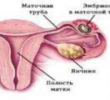 Izvanmaternične trudnoće: simptomi, znakovi, liječenje