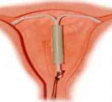 IUD kao oblik kontracepcije