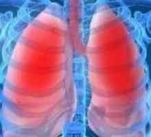 Upala pluća u odraslih: simptomi, liječenje