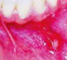 Upala usne šupljine: uzrokuje, liječenje