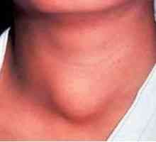 Upala štitnjače (tiroiditis): simptomi i tretman