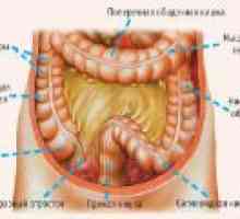 Upala sigmoidalne debelog crijeva: Simptomi i liječenje