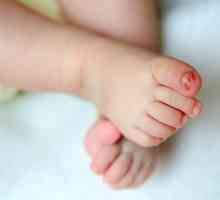 Ingrowing toenail: što učiniti