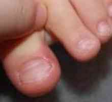 Urastao noktiju - uzroci, simptomi i tretman