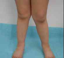 Kongenitalne displazija koljena