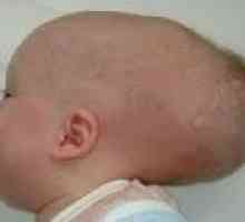 Kongenitalna hidrocefalus u beba: uzroci, simptomi, liječenje