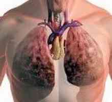 Svi tretmani plućne tuberkuloze