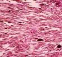 Otkrivanje i liječenje karakteristike vreteno stanica melanoma