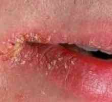 Perleches kutovi usta: simptomi, uzroci, liječenje
