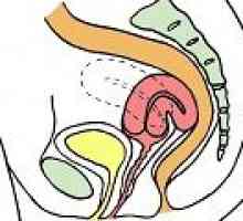 Savijanje maternice - uzroci, simptomi, liječenje