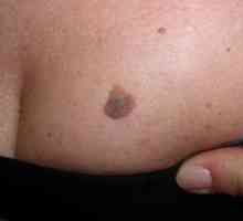 Maligni melanom: oblik i faza razvoja, komplikacija, za liječenje, prevenciju