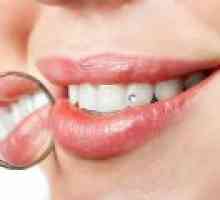 Zubni ispuni - Kriteriji za odabir