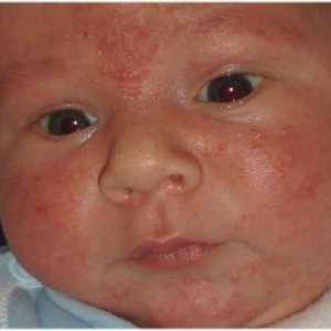 Alergijski osip kod djece