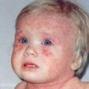 Atopijski dermatitis u djece, simptomi i liječenje