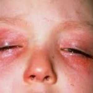 Alergija na oči što se očituje? Kako liječiti?