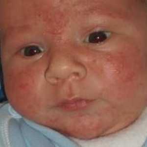 Alergija na mlijeko u dijete