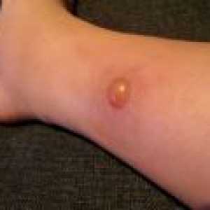 Alergije nakon ugriza komarca