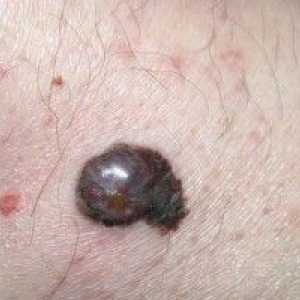 Test krvi u melanom: identifikaciju bolesti