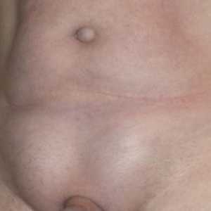 Anatomska značajka laparoskopske preponski kila