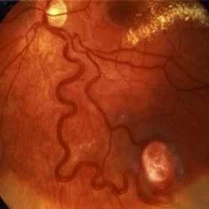 Mrežnice angiomatosis oči