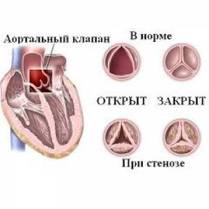 Aortalni stenoza