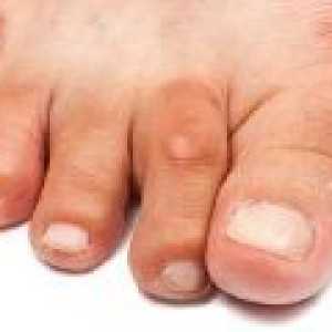 Artritis od prstiju i stopala, simptomi i tretman