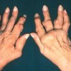 Artritis zglobova prstiju: Simptomi i liječenje
