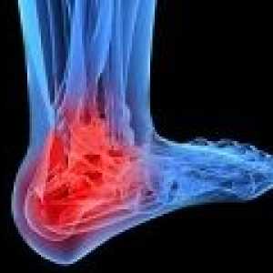 Osteoartritis skočnog zgloba: uzroci, simptomi, liječenje
