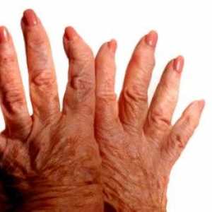 Osteoartritis prstima, simptomi i tretman