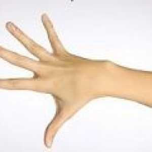 Osteoartritis prstima, zglobovi prstiju, kako liječiti?
