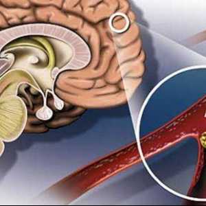 Moždani simptomi ateroskleroze i liječenje