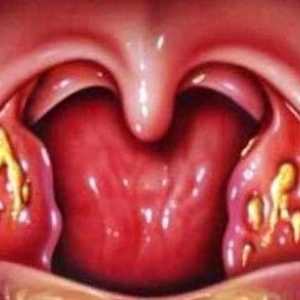 White čirevi u grlu: što je to?