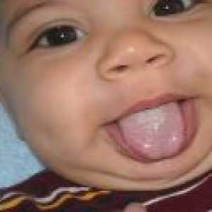 Bijeli jezik premaz u dojenčadi - uzroci, simptomi, liječenje