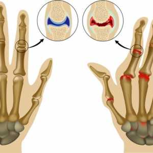 Biološko liječenje reumatoidnog artritisa: liječenje i lijekovi