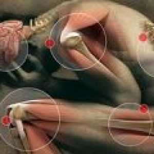 Ankilozantni spondilitis u žena