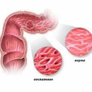 Crohnova bolest