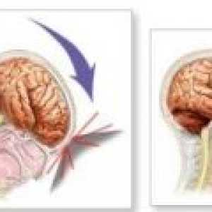 Traumatska ozljeda mozga - posljedice, rehabilitacija