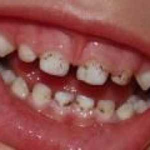Što učiniti ako je vaše dijete plaka na zubima?
