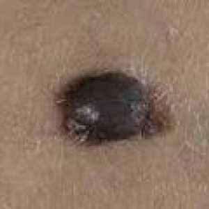 Što je melanom i kako bi se spriječilo njegovo pojavljivanje