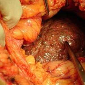 Ciroza jetre - glavni simptomi, vrste i liječenje tsiroz