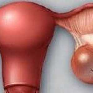 Cistadenom jajnika - uzroci, simptomi, liječenje