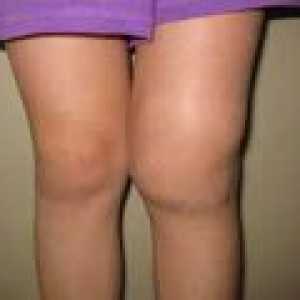 Deformacijom artroza koljena