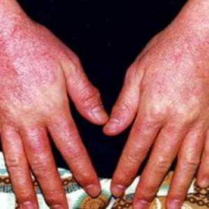 Dijagnoza i liječenje alergijskog dermatitisa