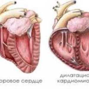 Dilatacijske kardiomiopatije, uzroci, simptomi, liječenje