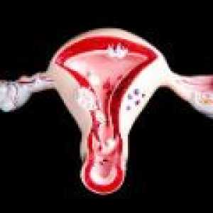Disfunkcionalno krvarenje maternice: uzroci, liječenje